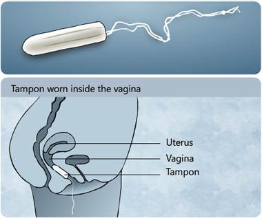 Illustration of a tampon and showing how a tampon is worn inside the vagina to absorb menstrual fluid coming out of the uterus - Menstrupedia
